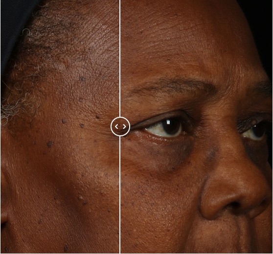 retinol